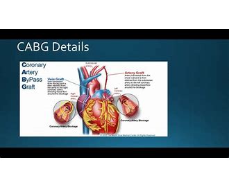 Cabg 読み方 – Cabg わかりやすく : 冠動脈バイパス術（CABG） – TEFCP